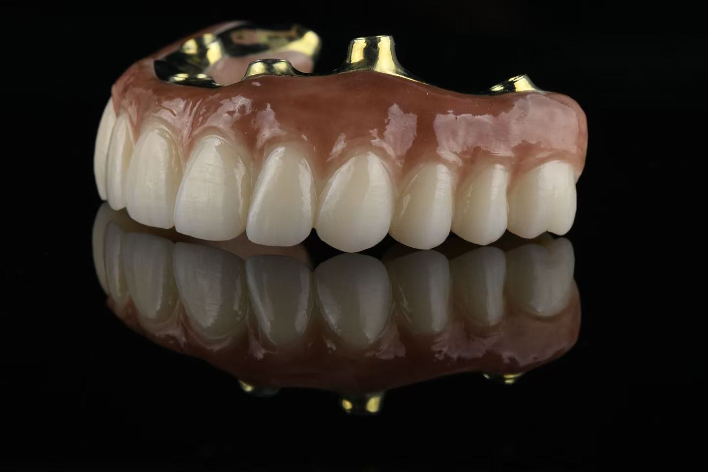 All on X full-arch restoration — angled view with implant connections