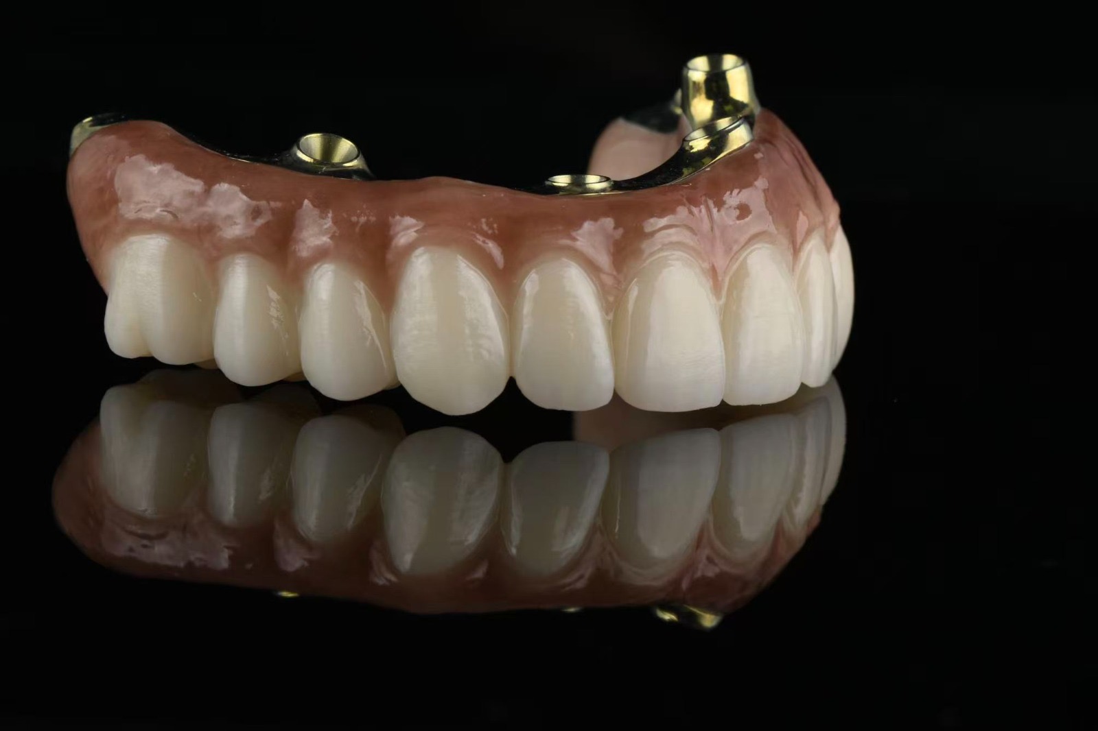 All on X full-arch restoration — opposite view with implant connections