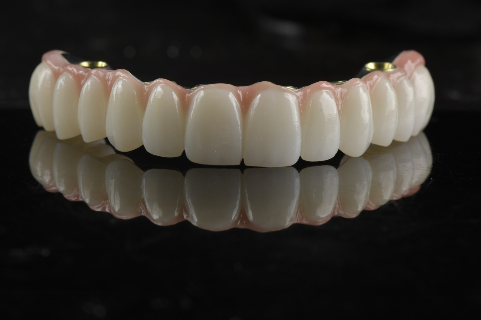 Full-arch composite restoration — front view