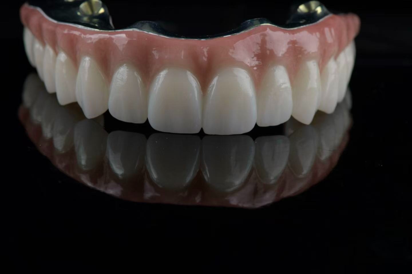 Metal framework with prosthesis — front view