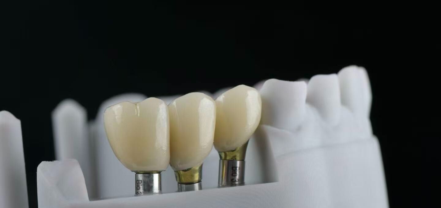 Implant-supported crowns on printed model — front view