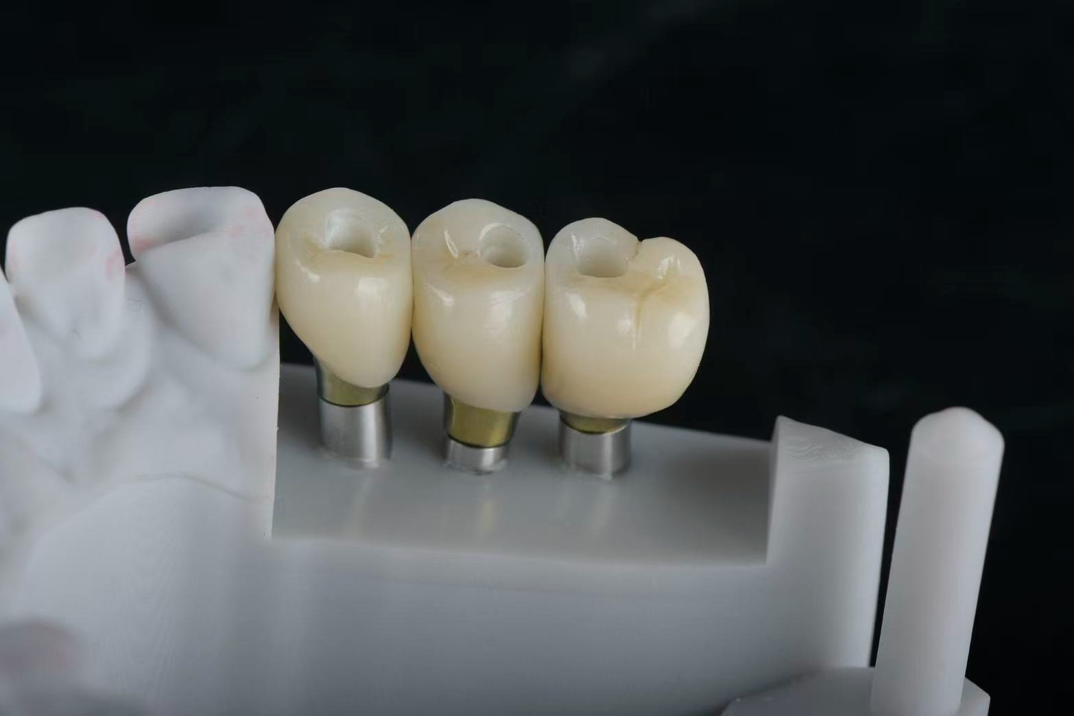 Implant crowns — occlusal view with screw holes