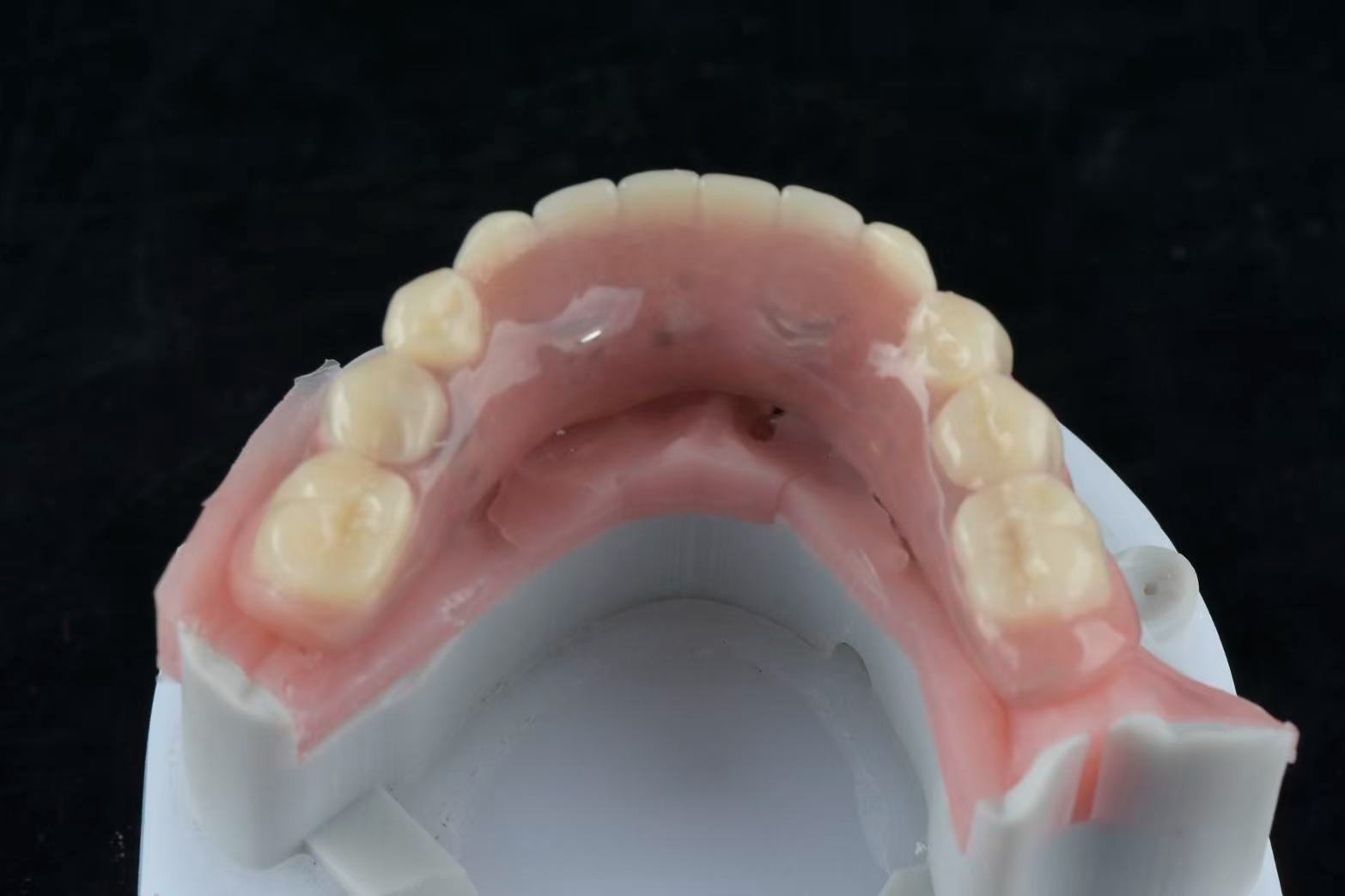Overdenture — occlusal view
